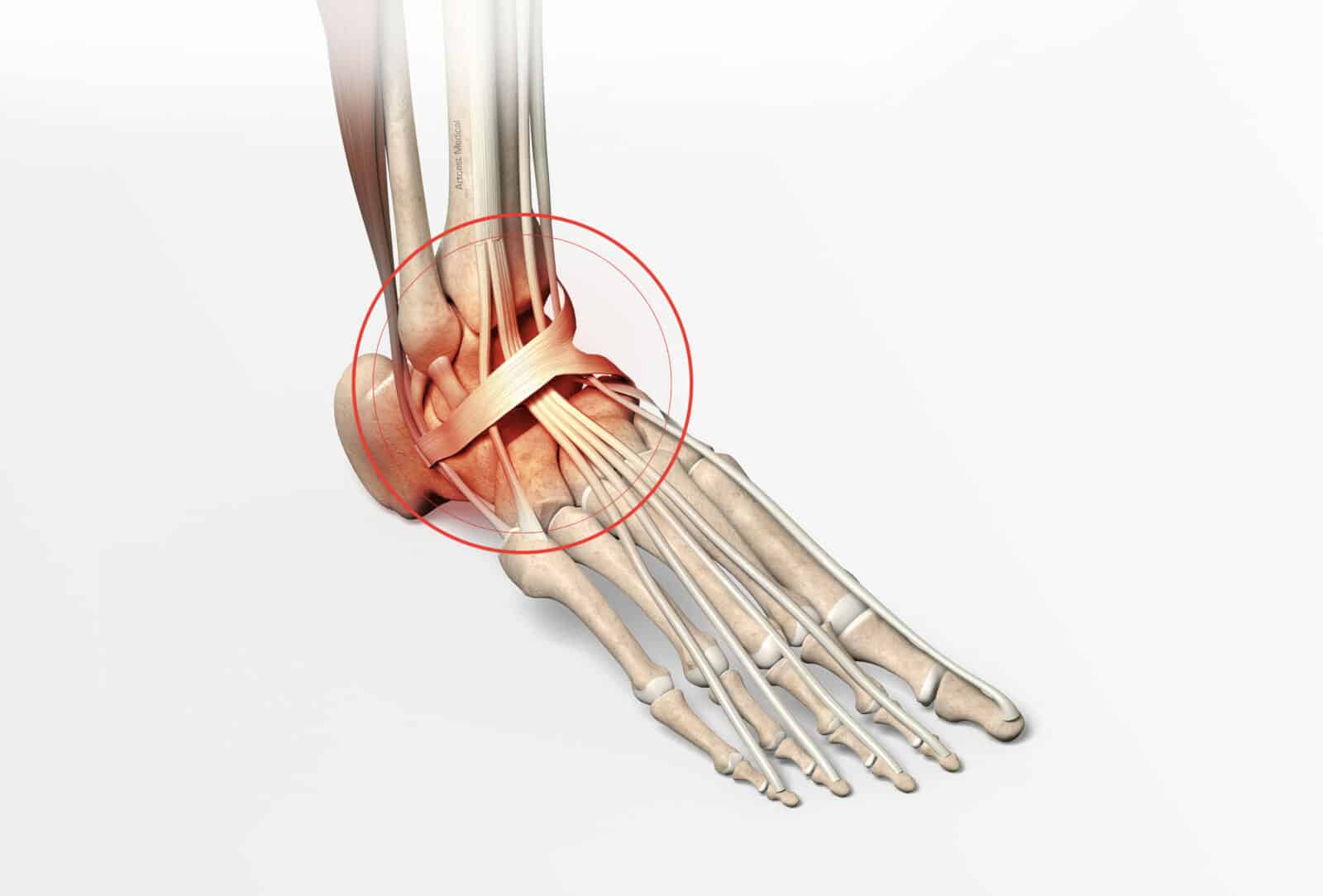 fractures du cou du pied: la fracture bimalléolaire et la fracture du pilon tibial
