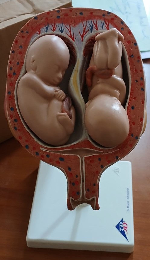 Twin pregnancy Practical work